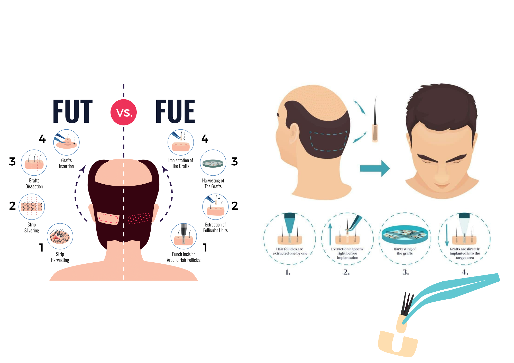 FUE hair transplantation before and after