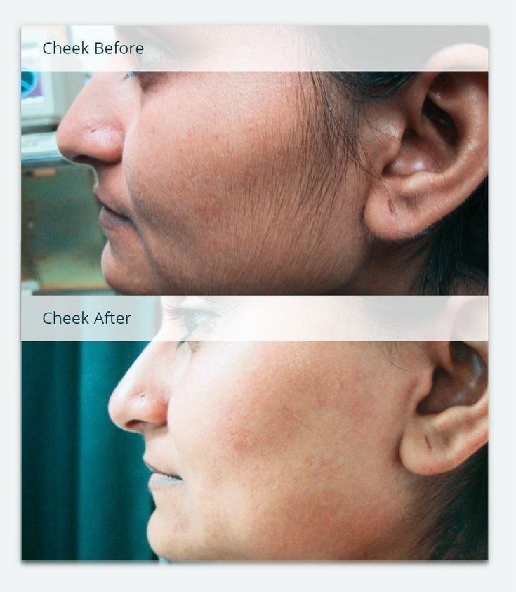 Unwanted hair removal before and after