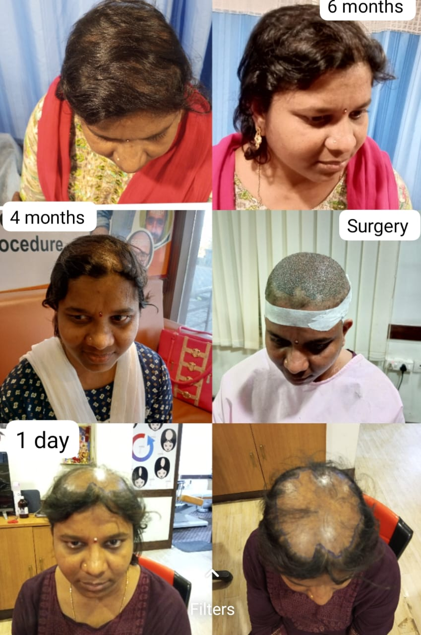 FUE hair transplantation treatment image A