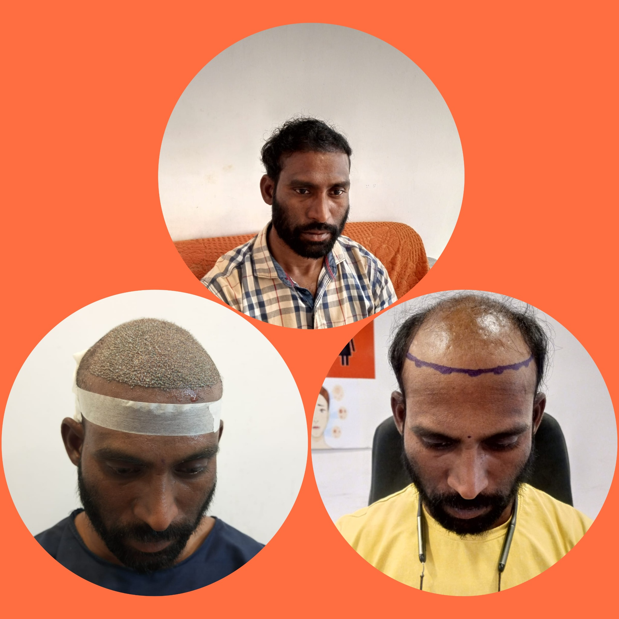 FUE hair transplantation treatment image B